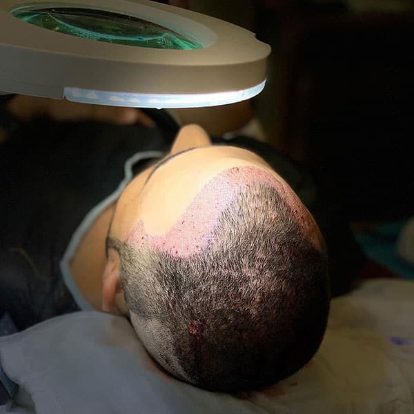 TRASPLANTE DE PELO EN TURQUIA
